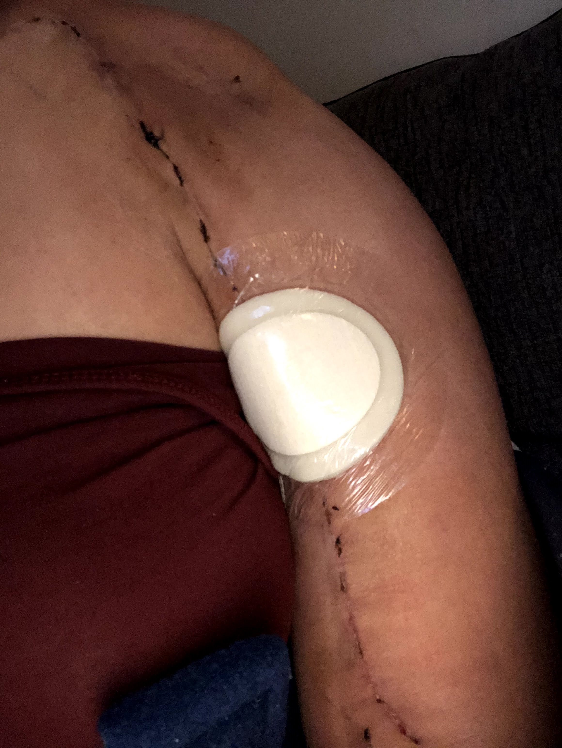 Beckiis arm following surgery